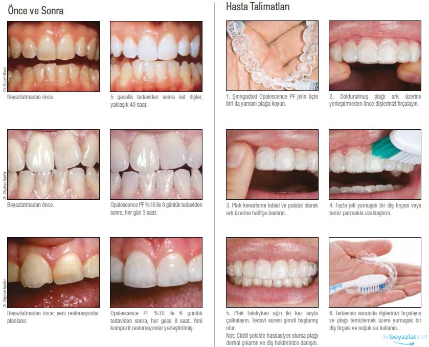 ultradent opalescence pf 16 ev tipi dis beyazlatma skt2023 fiyatlari ve ozellikleri