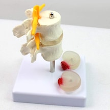 Fıtık Ve Disk Kayması Olan 2 Lomber Vertebralı Omurga Modeli - Om