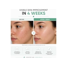 Lexroo Azelaik Asit Serumu Niacinamide & Çinko İle 30ml