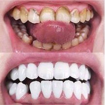 Bor İçerikli Lanbena Diş Taşı Temizlemede Etkili Ürün