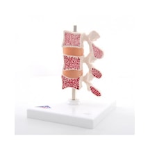 Osteoporoz Modeli, 3 Omur 01