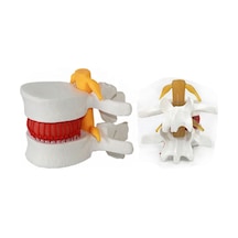 Disk Hernisi Fıtık Maketi Model 16