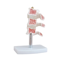 Osteoporoz Kesiti Modeli