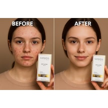 Sanjana Beauty Acne Serum 10 ML