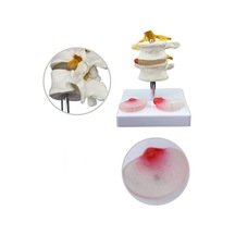 Lumbar Vertebra Disk Hernisi Omurga Modeli Model 4