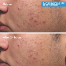 Murad Relief Spot Treatment - Lokal Sivilce Kurutucu Jel 1 Paket 1 X 15 Ml
