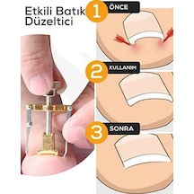 Batık Tırnak Çıkartıcı Orijinal Çelik Batan Tırnağı Düzeltme Aparatı Düzeltici Aleti Çıkarıcı Aparat