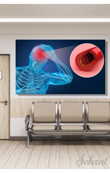 Yatay Tekli Kanvas Duvar Tablosu Nöroloji Doktor Klinik Hastane Beyin Damar Cerrahı Felç İnme Pıhtı 3d Çok Renkli Yatay Tekli Kanvas Duvar Tablosu Nöroloji Doktor Klinik Hastane Beyin Damar Cerrahı Felç İnme Pıhtı 3d Çok Renkli