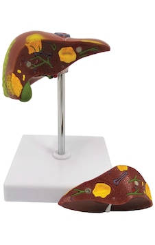 Karaciğer Patoloji Modeli, 2 Parçalı - Karaciğer Maketi 01 Karaciğer Patoloji Modeli, 2 Parçalı - Karaciğer Maketi 01