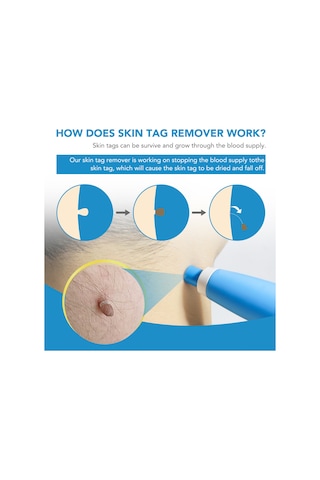 Vkemall Hızlı Ve Etkili Siğil Ve Et Beni Temizleme Seti - 2 Başlık + 40 Lastik Bant 112 Karakter