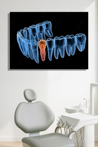 Diş İmplantı Yapay Diş Kökü Tıbbi Ve Anatomik 3 Boyutlu İllüstrasyon Yatay Kanvas Tablo Tekli 3659