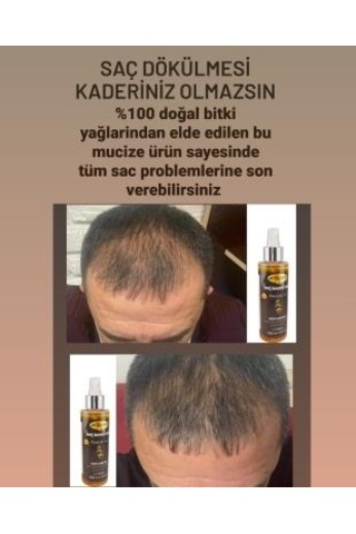 Dökülme Önleyici Saç Bakım Yağı Saç Çıkarıcı  Kök Uyarıcı Saçları