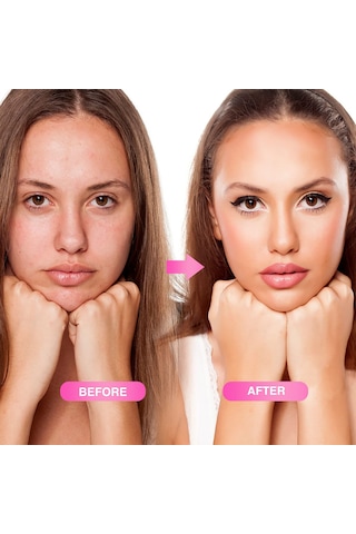 Vkemall Cilt Gençleştirme İğneli Rulo - Kırışıklık Ve İz Giderici Mikro İğne Terapisi 540 İğne, 0.3mm/1.0mm/3.0mm