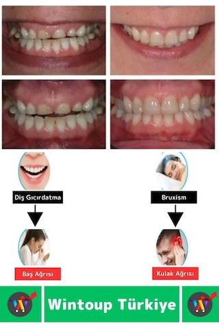 Diş Çene Sıkma Gıcırdatma Bruksizm Önleyici Gece Plağı Koruyucu Uyku Aparatı Protez Kaplı 4 Adet