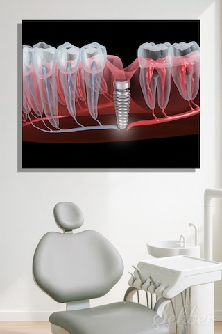 Dental İmplant Tıbbi 3d Çizim Yatay Kanvas Tablo Tekli Ağız Diş Sağlığı Dişçi Poliklinik Hastane 3497