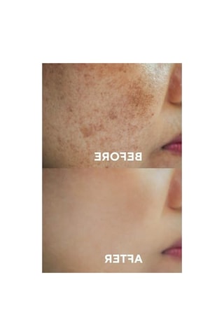 30 Ml Leke Karşıtı Cilt Serumu İle Cilt Tonu Eşitleme