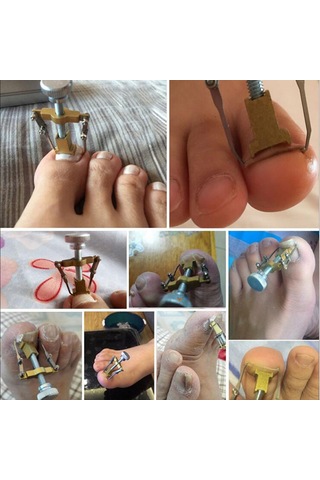 Qingmipy Altıparmak Tırnağı Düzeltme Aracı - İçbükey Tırnak Sorunu Çözücü - Paslanmaz Çelik Altın