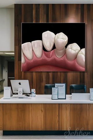 Maryland Köprü Kanatlı Köprü Sisteminin 3d Tıbbi Modellemesi Yatay Kanvas Tablo Tekli 3672