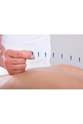 Akupunktur iğnesi kuru iğne, Acupuncture needle 0.35*100mm