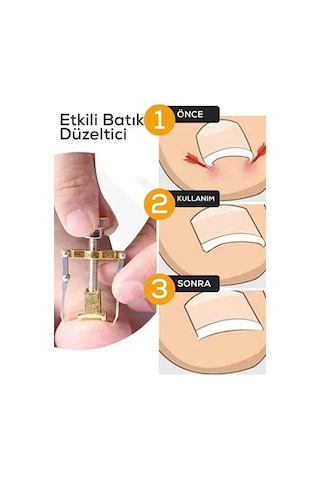 Batık Tırnak Çıkartıcı Çelik Batan Tırnağı Düzeltme Aparatı Düzeltici Aleti Çıkarıcı Aparat
