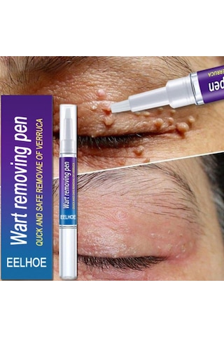 Cilt Etiketi Sökücü Benlere Karşı Tıbbi Ağrısız Hızlı Kaldırma Genital Siğil Akne Leke Tedavisi Papillomlar Düz Siğil Güzellik Sağlık