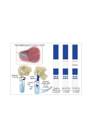 Amnisure Fetal Membran Yırtığı Testi