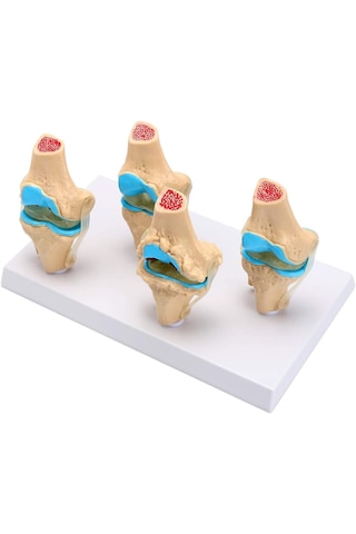 Diz Eklemi Modeli Osteoporoz Durumu Modelleri - Diz Eklemi Maketi