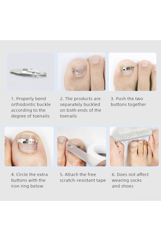 Suofeng Batık Tırnak Düzeltme Seti - Paslanmaz Çelik Tırnak Düzeltici Ve Bant İle Ayak Bakımı