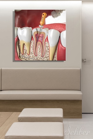 Endodontik Tedavi Kanal Tedavisi Prosedürü 3d Tıbbi İllüstrasyon Yatay Kanvas Tablo 3862 Çok Renkli
