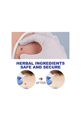 Cilt Etiketi Sökücü Benlere Karşı Tıbbi Ağrısız Hızlı Kaldırma Genital Siğil Akne Leke Tedavisi Papillomlar Düz Siğil Güzellik Sağlık