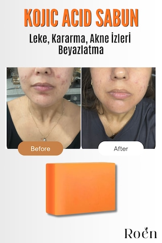 Doğal Kojik Asit Sabunu, Cilt Beyazlatıcı, Leke Giderme, Kararma, Akne, Güneş Lekeleri 110gr Kokusuz