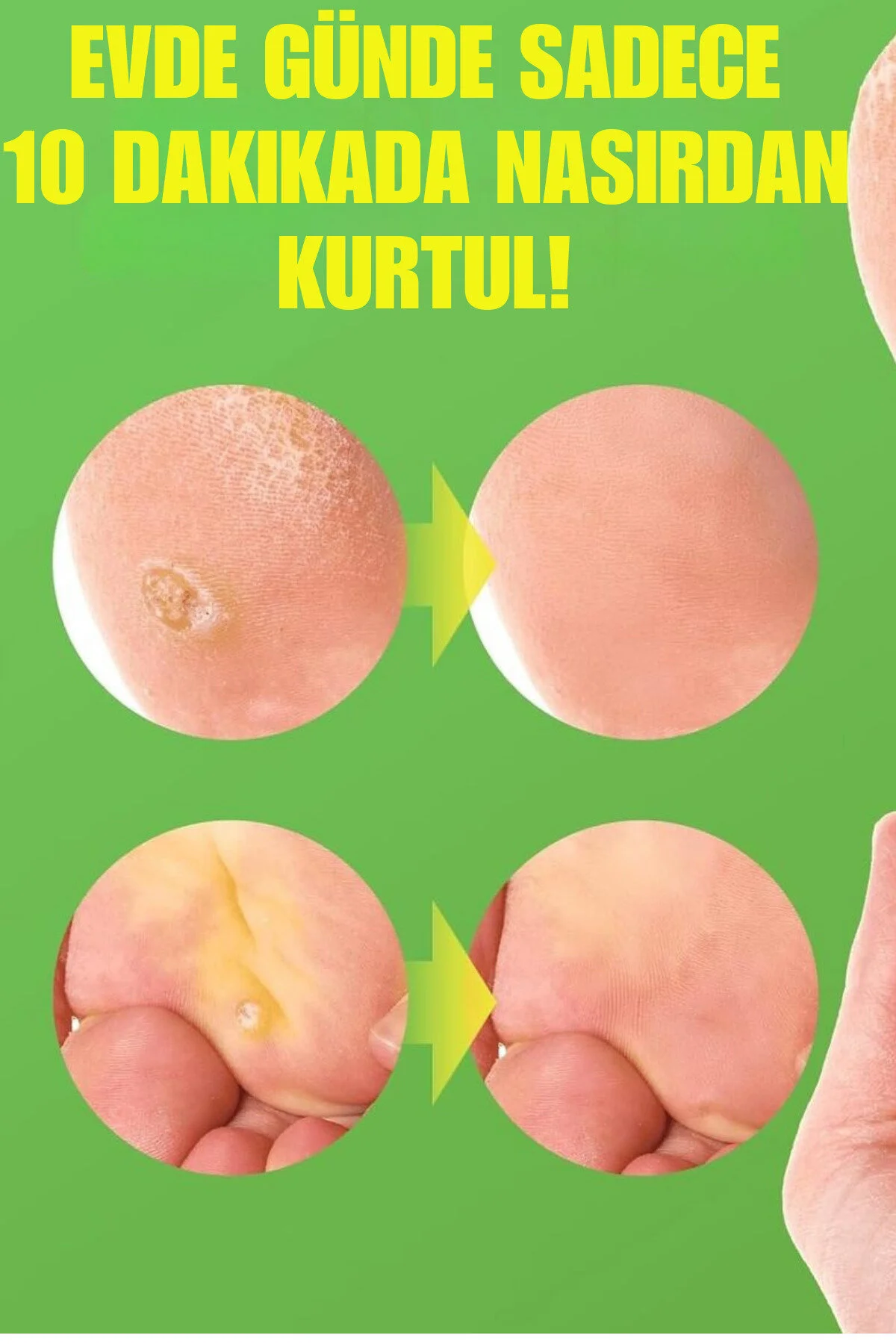 Ulensy %40 Salisilik Asit Nasır Seti 24'lü