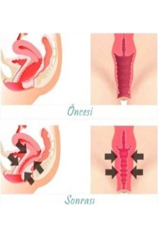 Northcity Süper Vagitight Kadınlar Için Genital Bölge Krem 100 Ml X 2 Adet