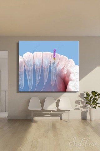 Endodontik Kök Kanal Tedavi Sürecinin 3d Tıbbi İllüstrasyonu Yatay Kanvas Tablo Tekli 3746 Çok Renkli