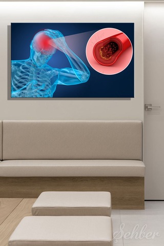 Damar Tıkanıklığı Tıbbi İllüstrasyon Yatay Kanvas Tablo Tekli 3449