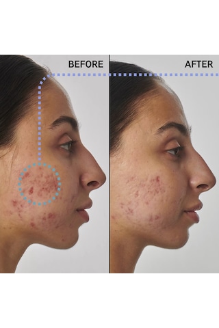 The Inkey List Scar Mark And Wrinkle Solution With 1% Retinol Serum 30 ML