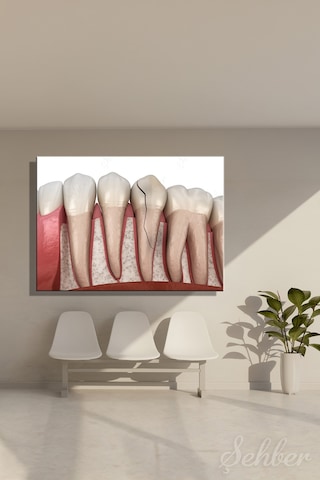 Diş Eti Çene Kemiği Dikey Çatlak Diş Krack Diş 3d Tıbbi İllüstrasyon Kanvas Tablo Yatay Tekli 3669