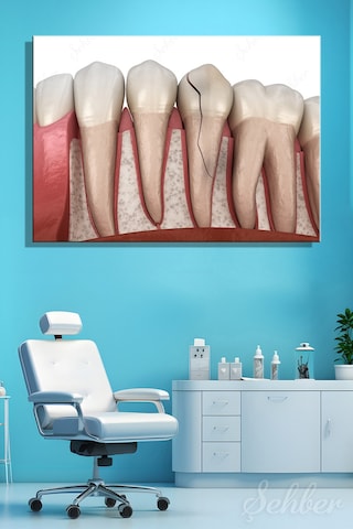 Diş Eti Çene Kemiği Dikey Çatlak Diş Krack Diş 3d Tıbbi İllüstrasyon Kanvas Tablo Yatay Tekli 3669