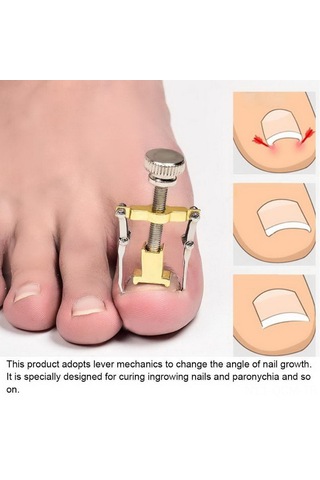 Qingmipy Altıparmak Tırnağı Düzeltme Aracı - İçbükey Tırnak Sorunu Çözücü - Paslanmaz Çelik Altın