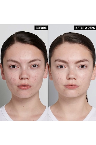 The Inkey List Succinic Acid Acne Treatment 15 ML