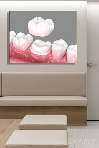 Diş Tacı Yerleşimi Diş Kronunu 3d Tıbbi İllüstrasyon Tekli Kanvas Tablo Yatay 3588