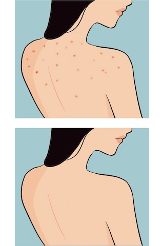 Skin Sensual Buttoks Buttne Vücut Maskesi | Vücut Sivilceleri ve Pürüzlere Karşı | 2 Parça