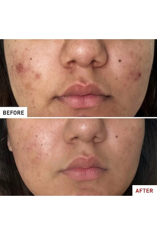 Erborian Centella Acné Care - Yatıştırıcı Sıvı 30 Ml