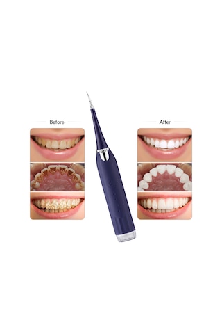 Wezone Evde Kullanan Elektrikli Diş Taşı Temizleyici - Ipx7 Su Geçirmezli, Mavi, 2 Fırça + 2 Uçlu Başlık