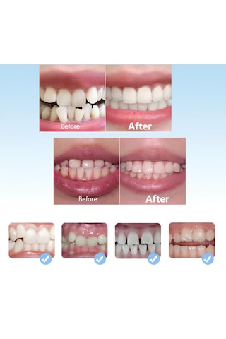 Çocuk Diş Silikon Ortodontik Parantez 3 Lü Set D1 D2 D3 Şeffaf