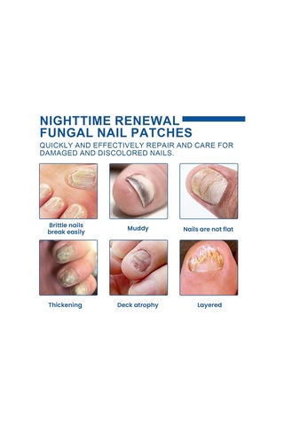 Yifomall 32 Adet Onyxomykoz Ve İçine Giren Tırnak Tamir Bandı - Su Geçirmez, Nefes Alır, Tırnak Büyüme Açısını Düzeltir Bakım Bandı