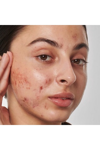 The Inkey List Scar Mark And Wrinkle Solution With 1% Retinol Serum 30 ML