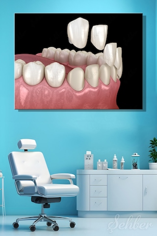 Diş Kaplama Veneer Uygulaması Sürecinin 3 D Aşamaları Tıbbi İllüstrasyon Yatay Kanvas Tekli Tablo 3671