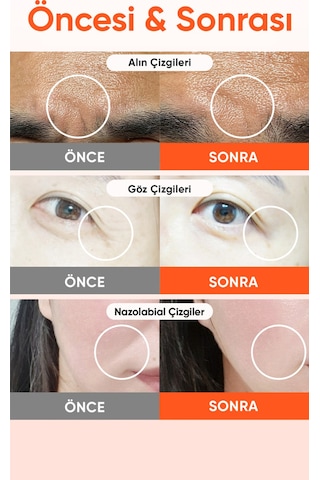 Retinol Ve Pdrn Mikro İğneli Göz Altı Ve Nazolabial Çizgi Reti-rn Microcone Patch Slim 6 Lı