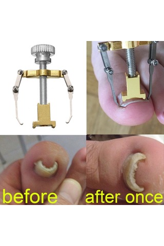 Qingmipy Altıparmak Tırnağı Düzeltme Aracı - İçbükey Tırnak Sorunu Çözücü - Paslanmaz Çelik Altın